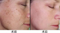 超皮秒價格，超皮秒廠家哪個比較好？
