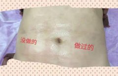 去妊娠紋機(jī)器多少錢(qián)一臺(tái)？美容院去除妊娠紋機(jī)器設(shè)備價(jià)格