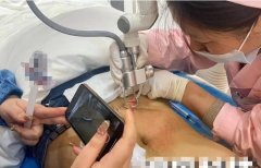 妊娠紋用什么儀器能去除？妊娠紋修復(fù)儀器廠家_最新祛妊娠紋的儀器